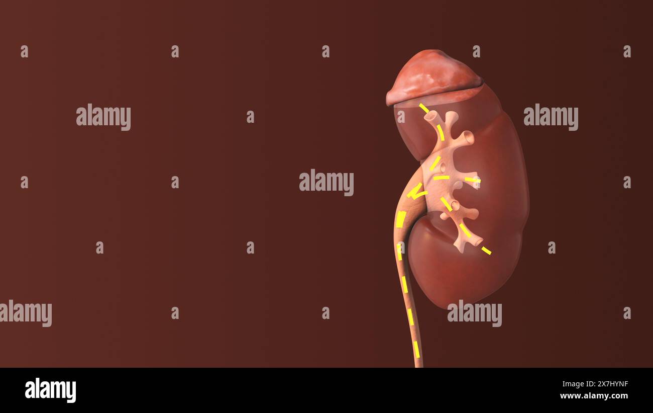 Chronic kidney disease human hi-res stock photography and images - Alamy