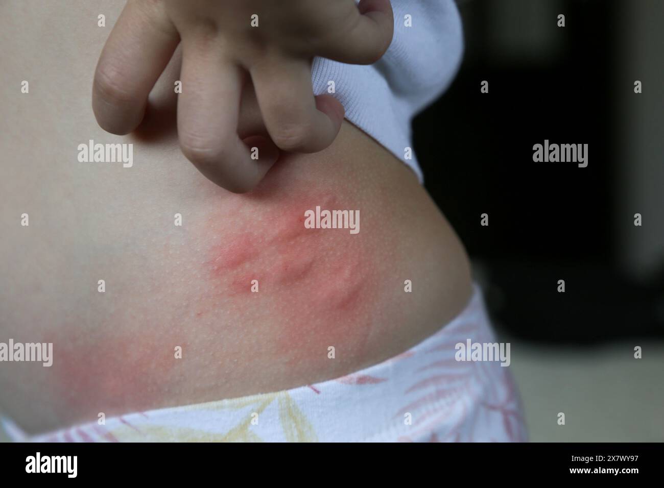 Charlie Insect Rash Red, swollen and itchy spots on skin caused by insect bites or allergy ...