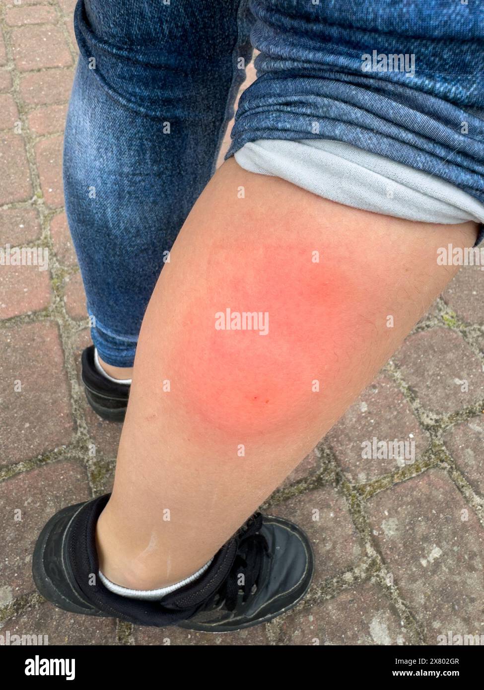 Allergy after a mosquito bite on the calf Stock Photo - Alamy