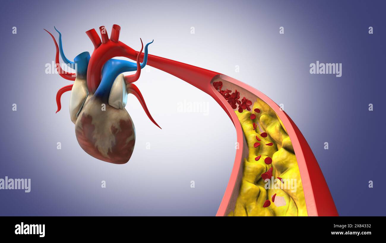 Cholesterol plaque in artery blocking blood flow Stock Photo