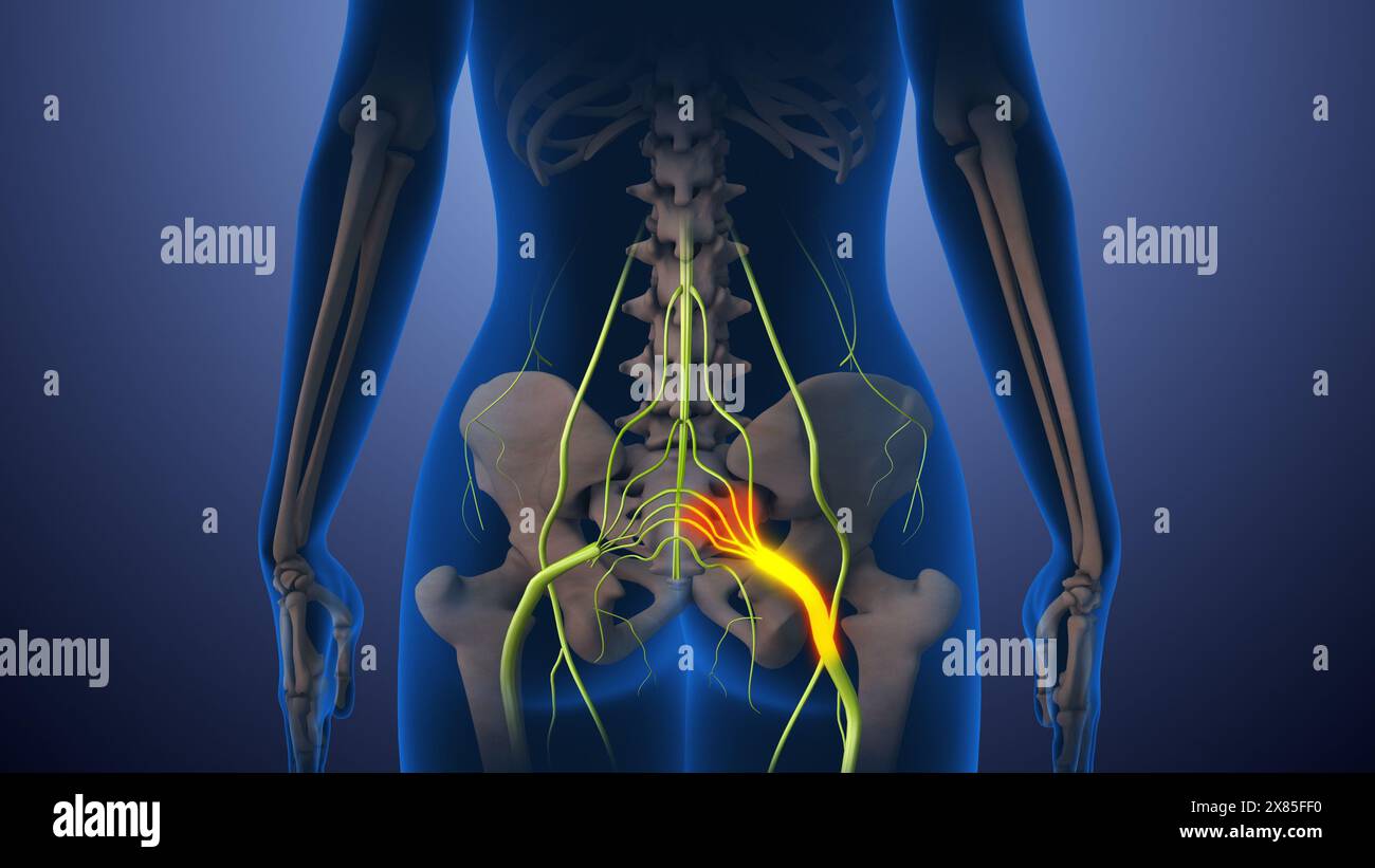 Sciatica nerve pain lower back through hips to leg Stock Photo Alamy