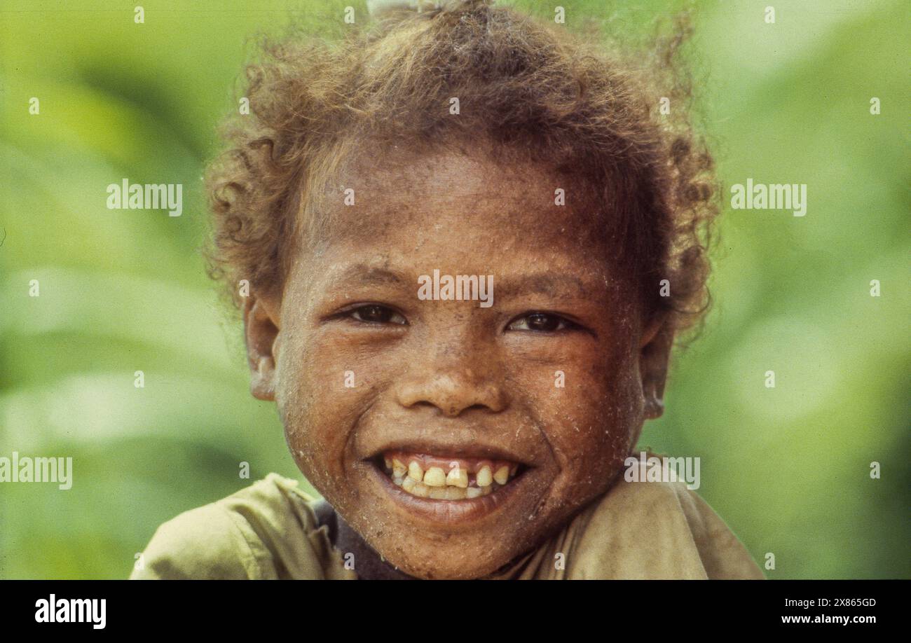 Philippines, Palawan, boy has a shortage of zinc and this makes the