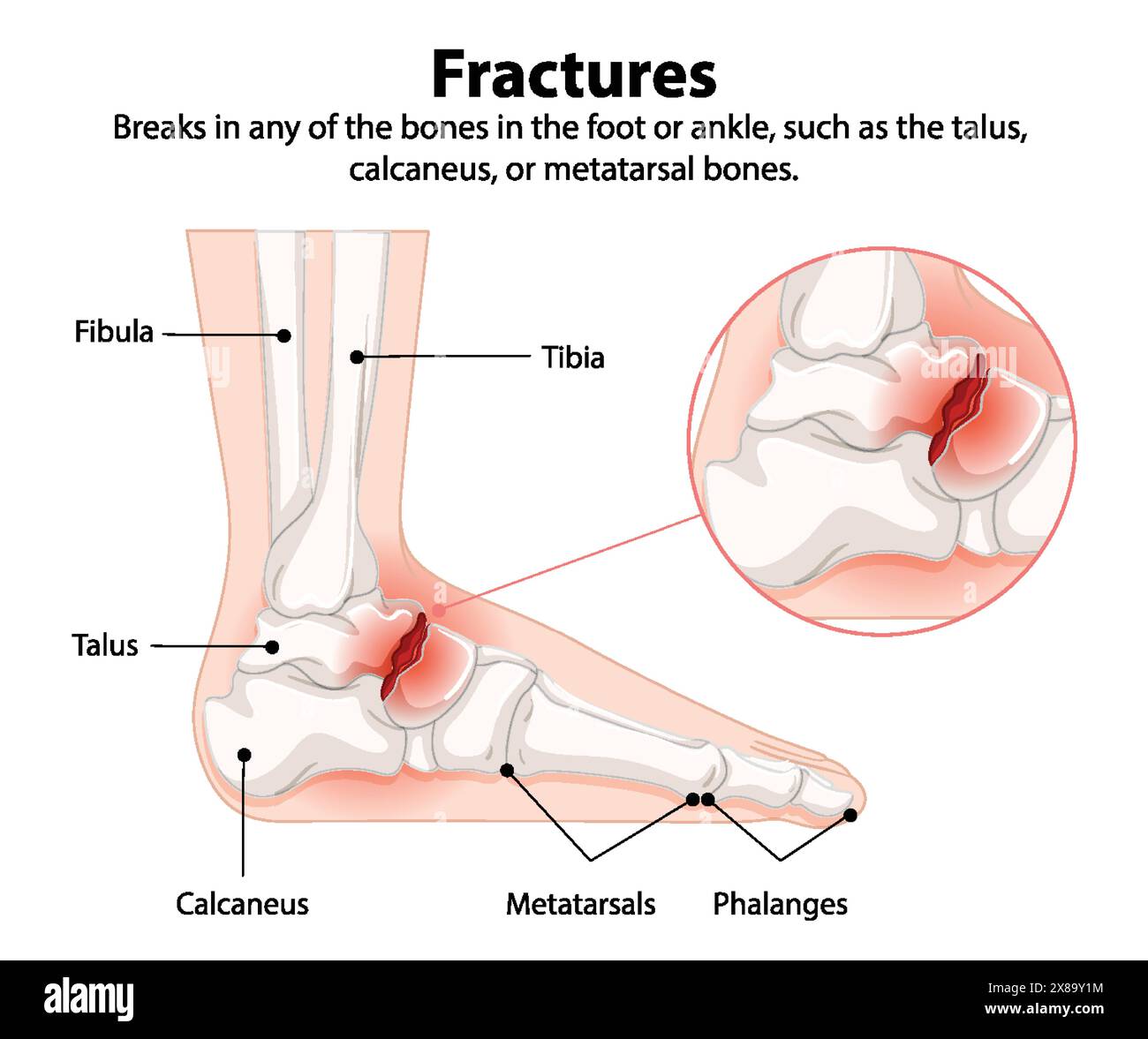 Illustration of fractures in foot and ankle bones Stock Vector