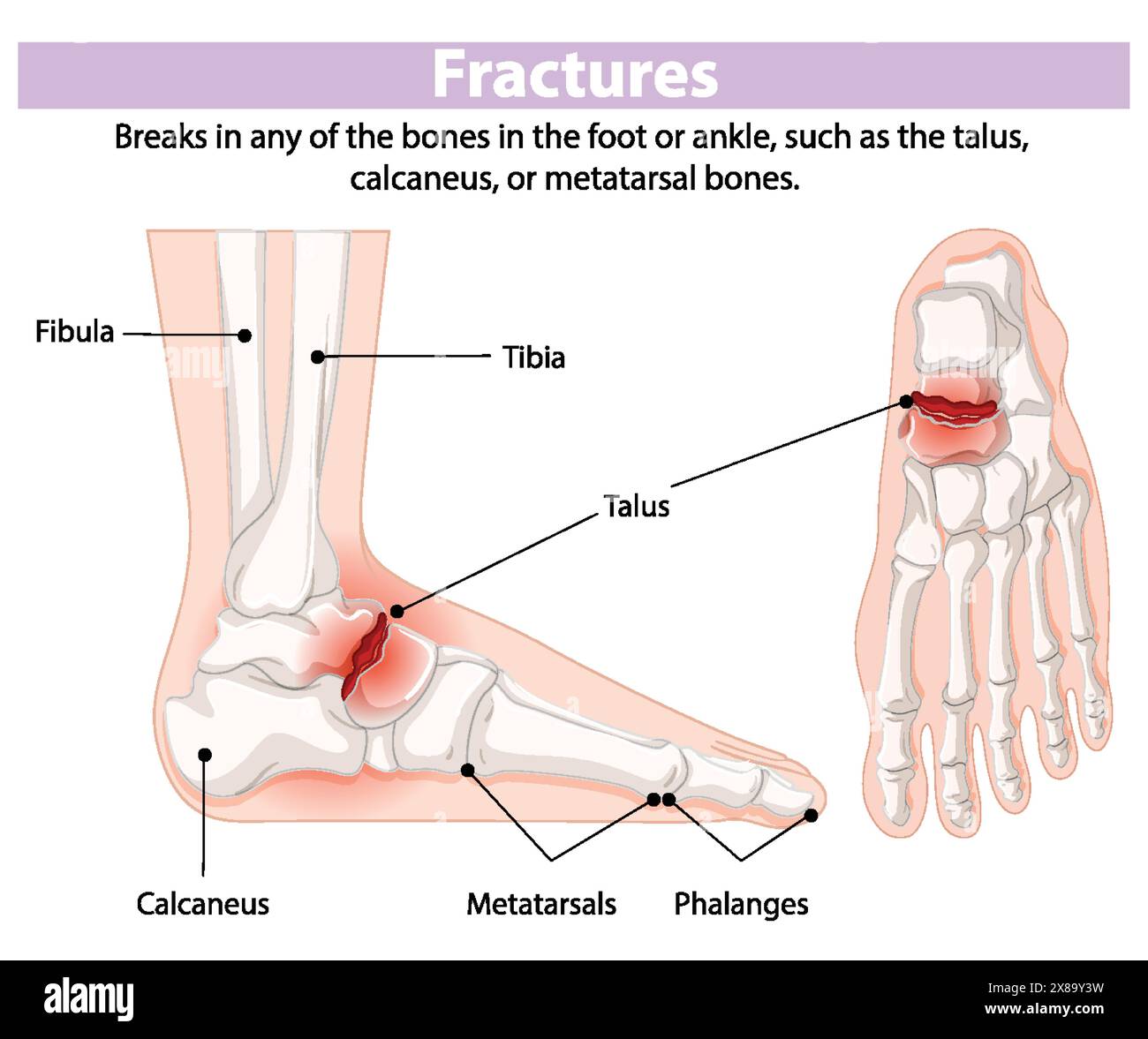 Illustration of foot and ankle bone fractures Stock Vector Image & Art ...