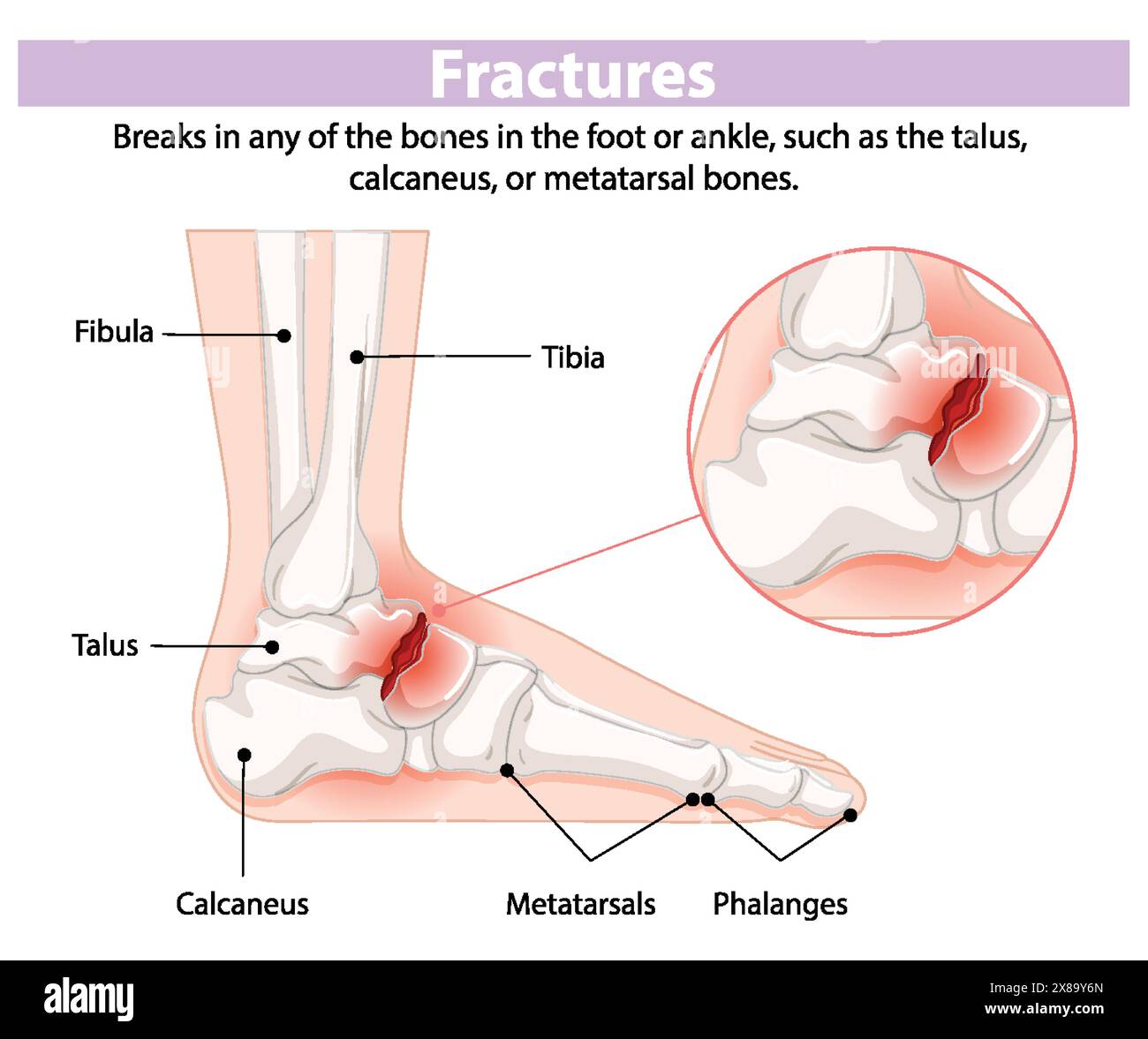 Illustration of foot and ankle bone fractures Stock Vector