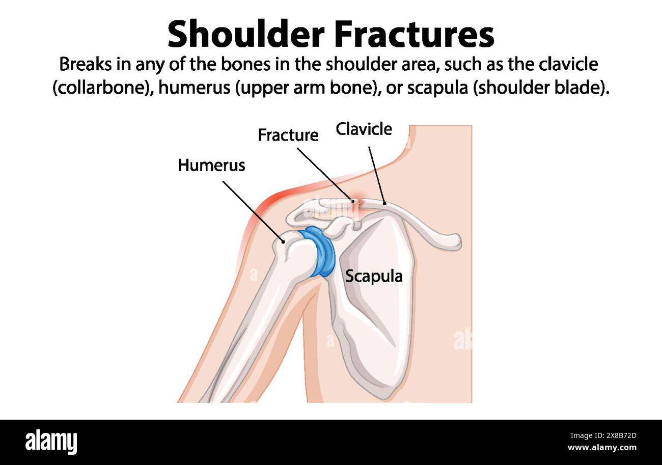 Diagram of shoulder fractures and affected bones Stock Vector