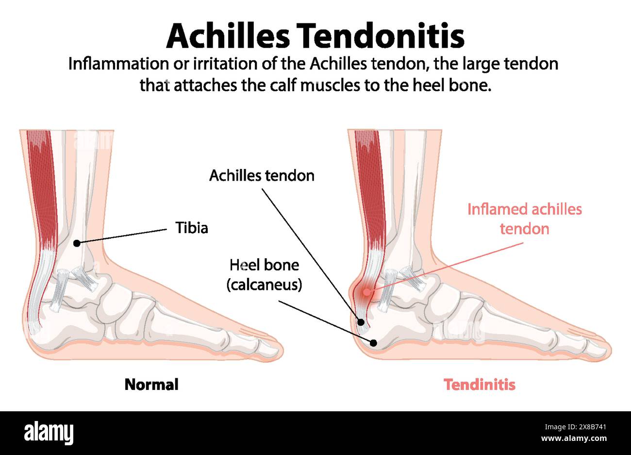 Comparison of normal and inflamed Achilles tendon Stock Vector Image ...