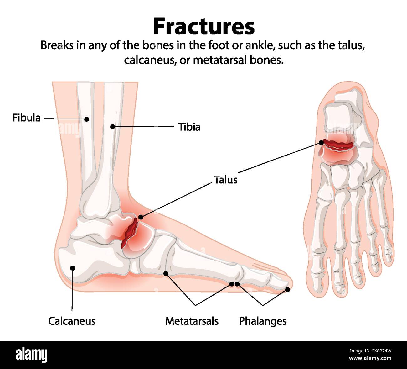 Illustration of foot and ankle bone fractures Stock Vector