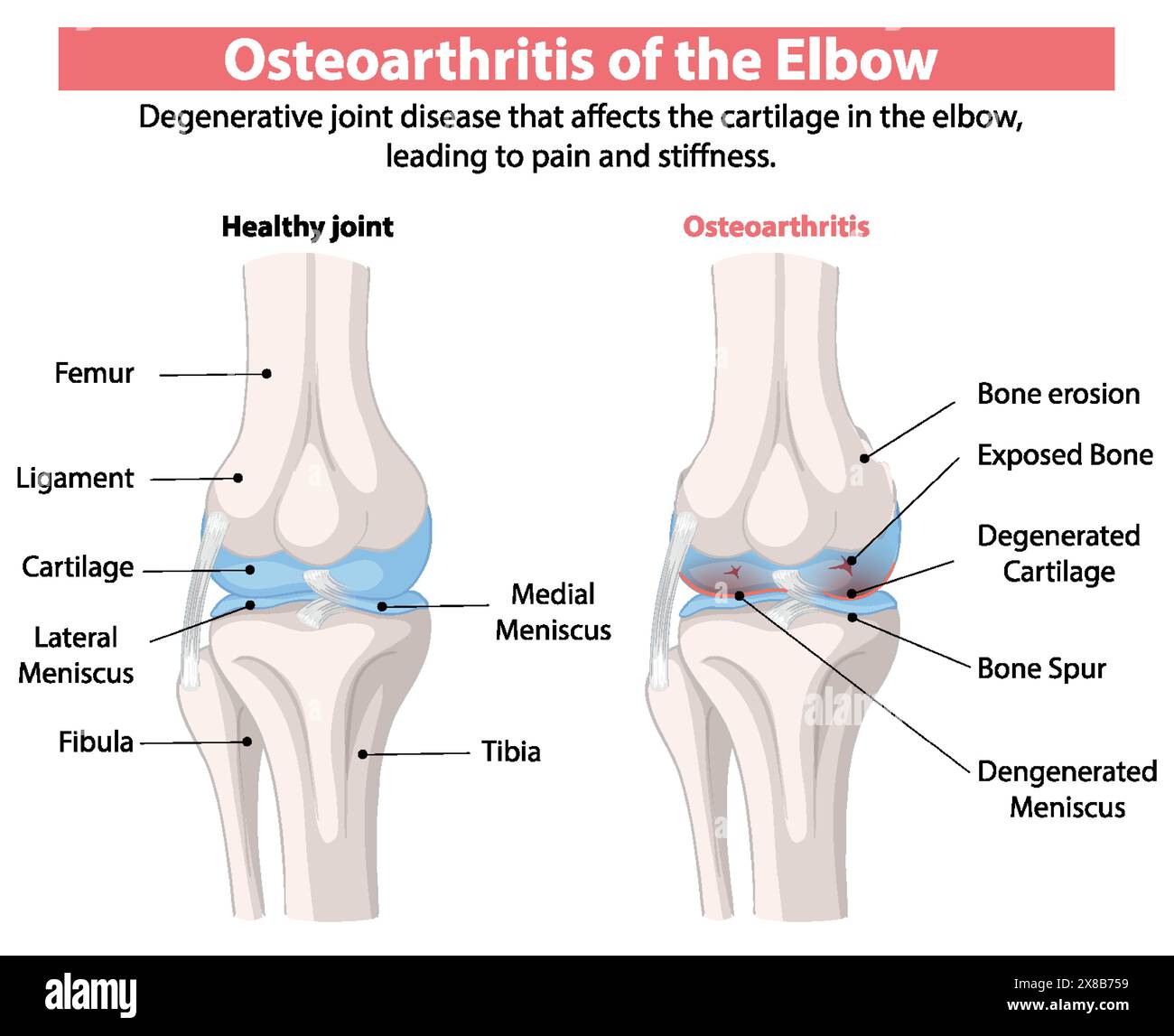 Elbow joint comparison hi-res stock photography and images - Alamy
