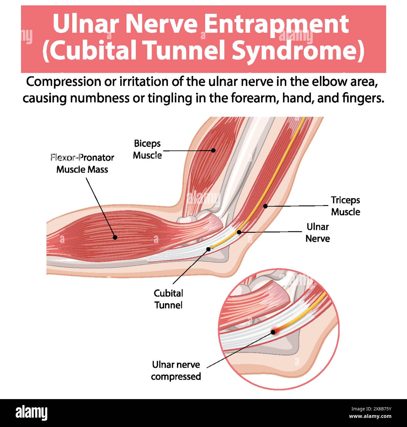 Detailed Anatomy Of Cubital Tunnel Syndrome Stock Vector Image Art Detailed anatomy of cubital tunnel syndrome stock vector image art