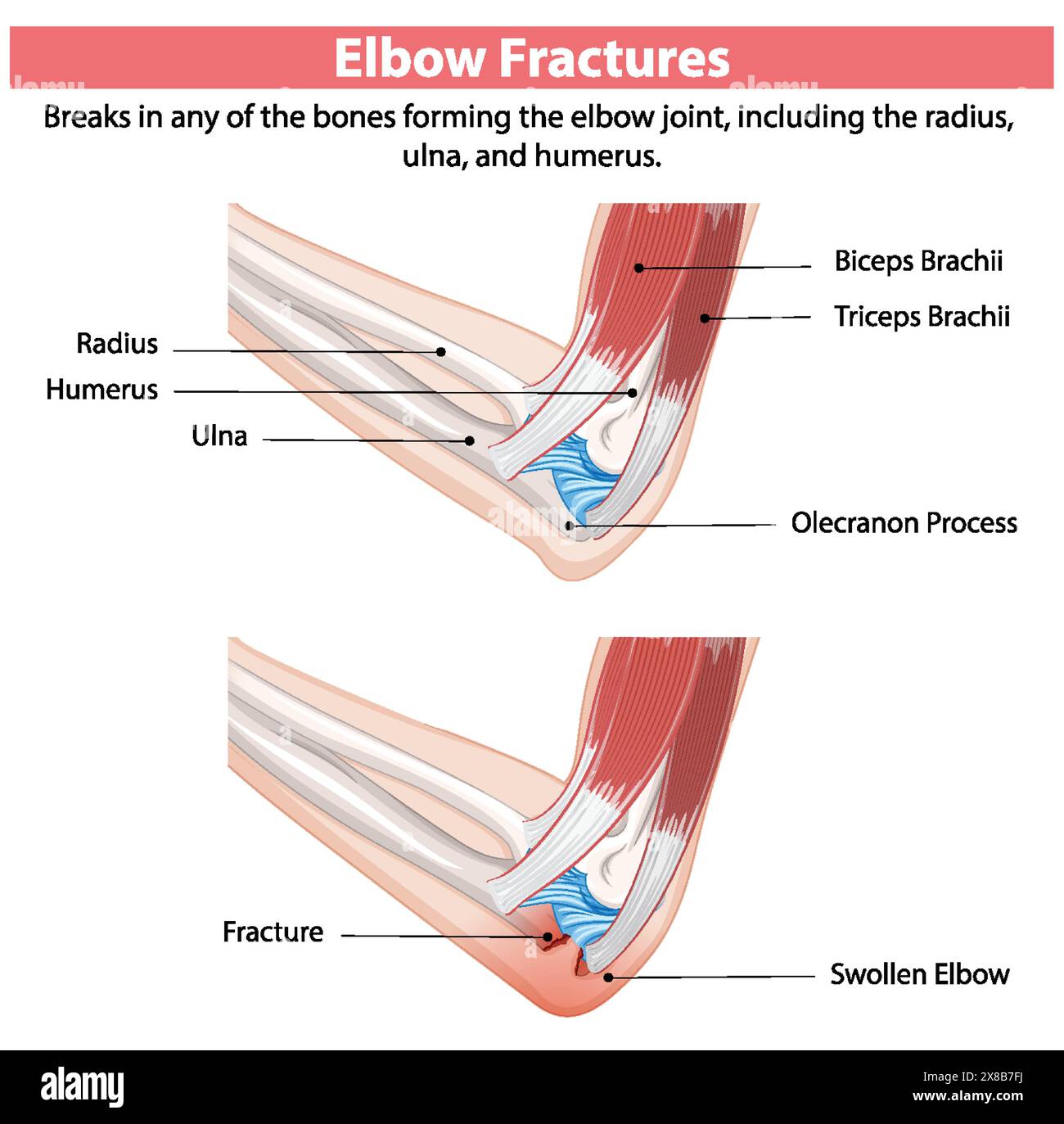 Detailed diagram of elbow fractures Stock Vector