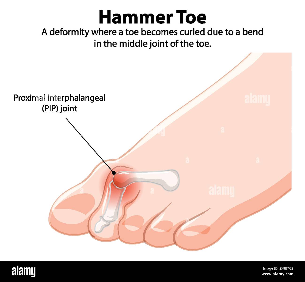 Hi Resolution Toes Toe deformity diagram hi-res stock photography and images - Alamy