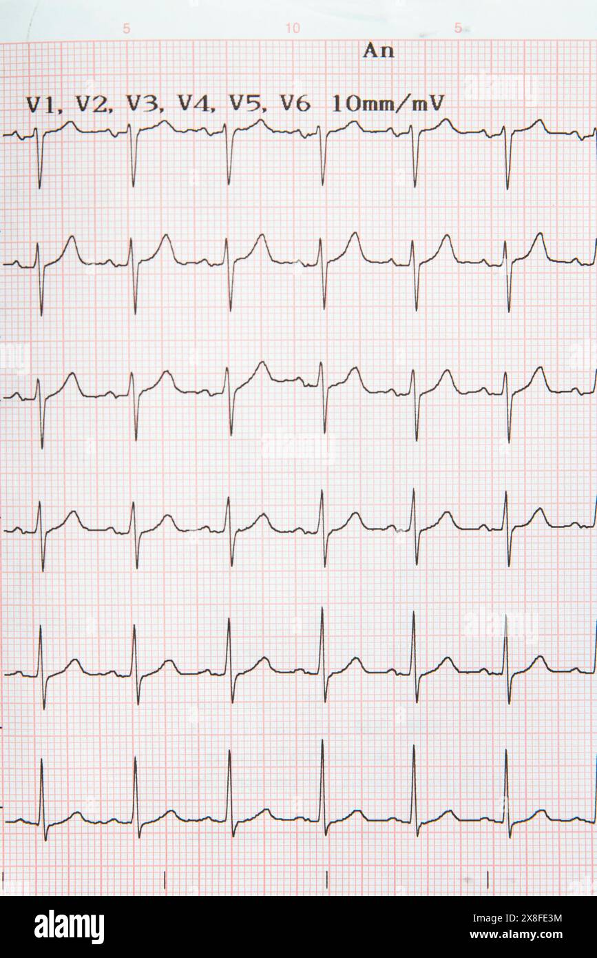 Electrocardiogram, human heart. Ecg 013843 007 Stock Photo