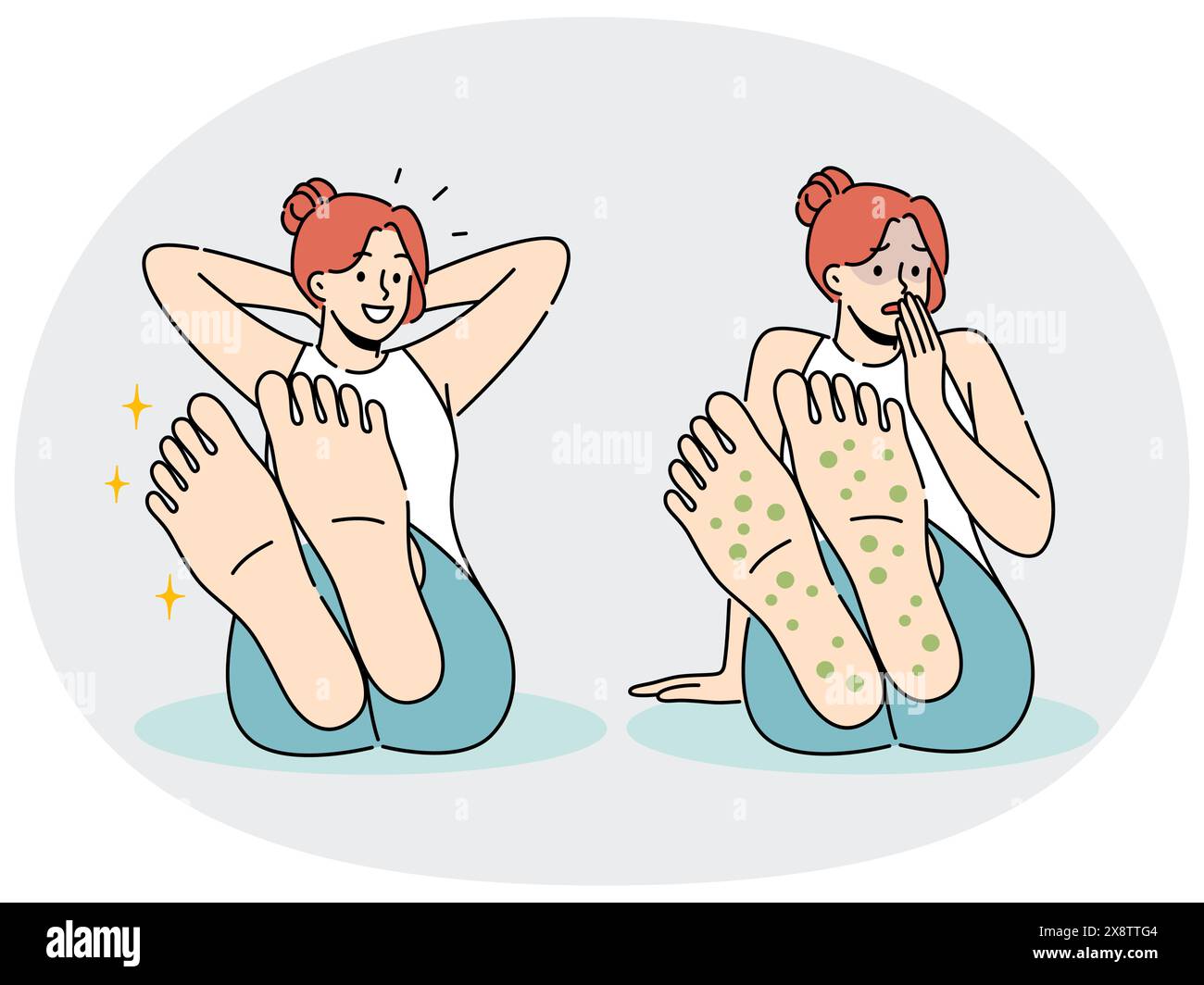 Woman with rash on feet suffers from allergies and fungal infection