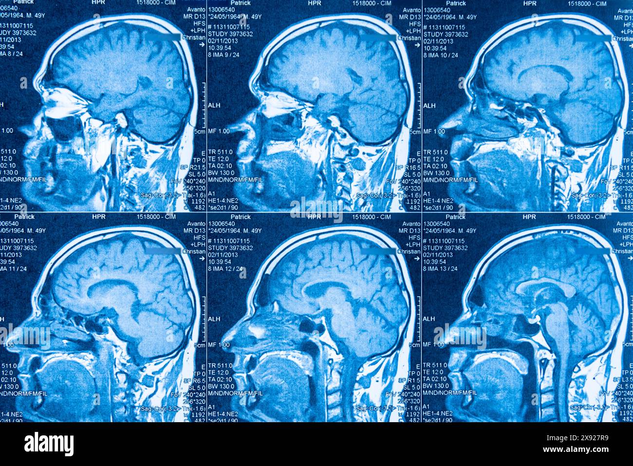 Brain scan ct side hi-res stock photography and images - Alamy