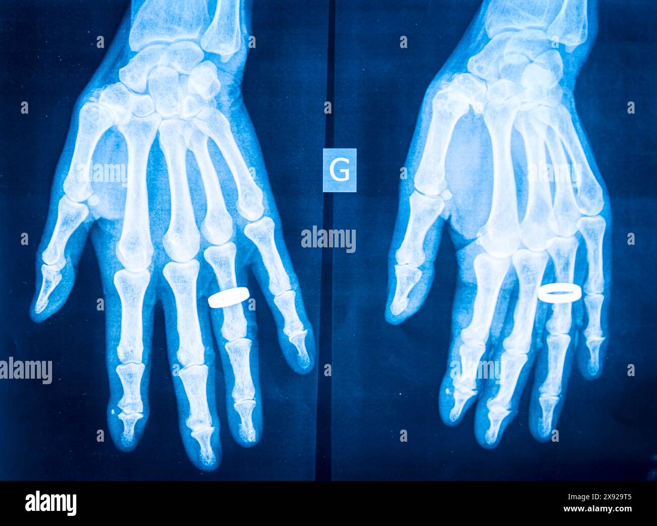 X-ray of rheumatism in the hands. Rheumatism 013843 010 Stock Photo - Alamy