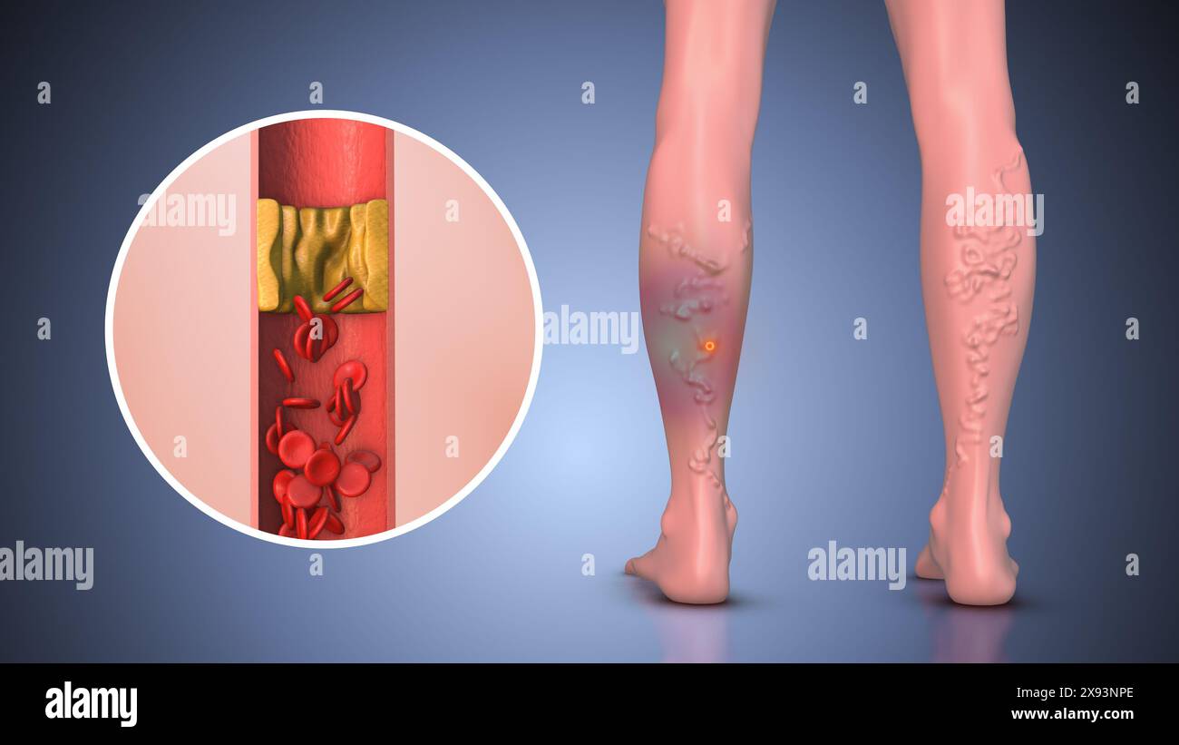 Peripheral pain in human leg with varicose vein Stock Photo