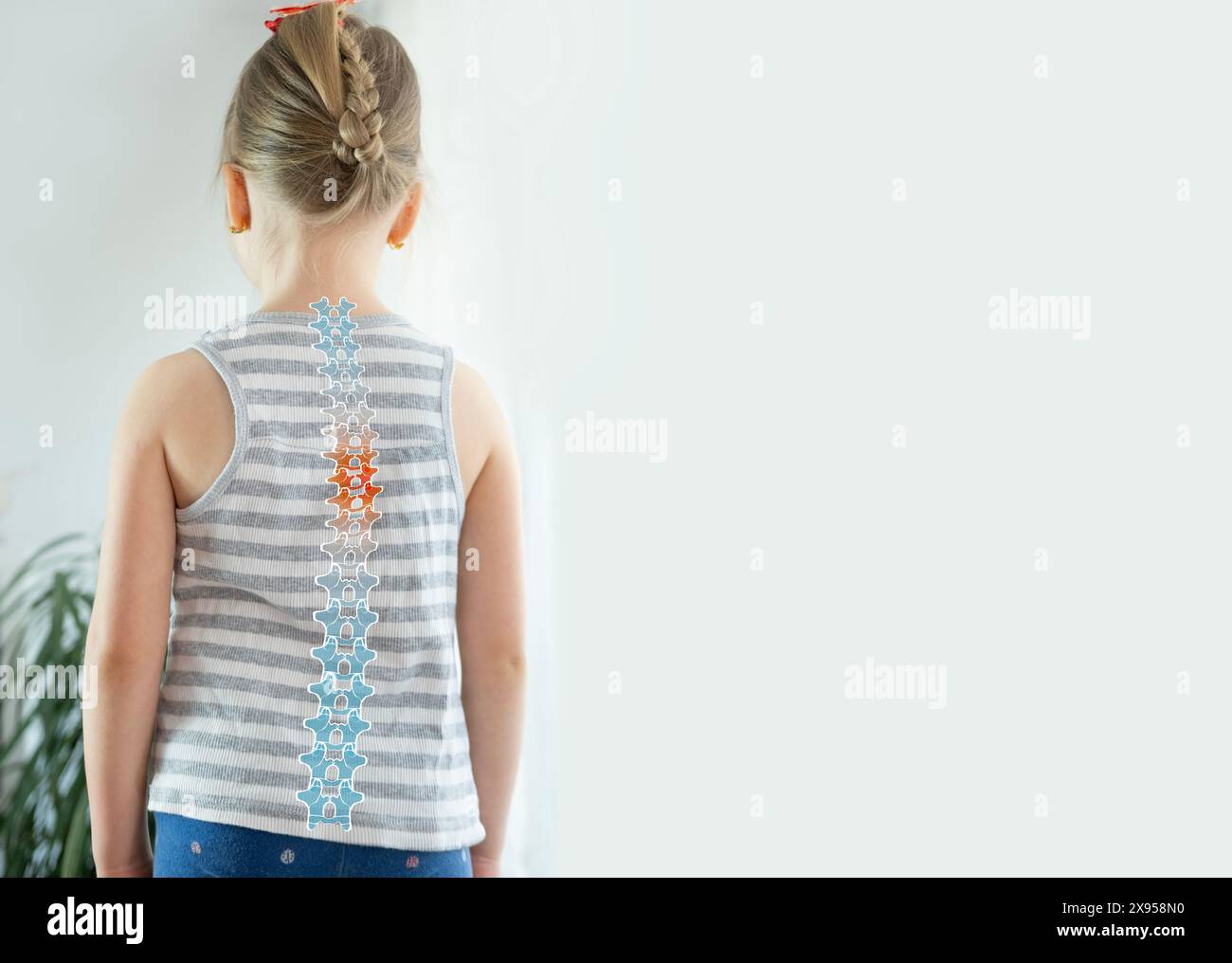 back little girl with scoliosis, child 5 years old crookedly standing, spine deformity curved, orthopedic condition, need for medical attention Stock Photo