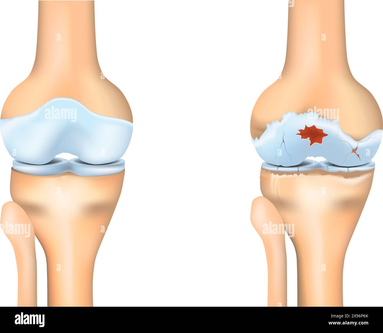 Knee osteoarthritis. Joint degeneration. Vector illustration. Stock Vector
