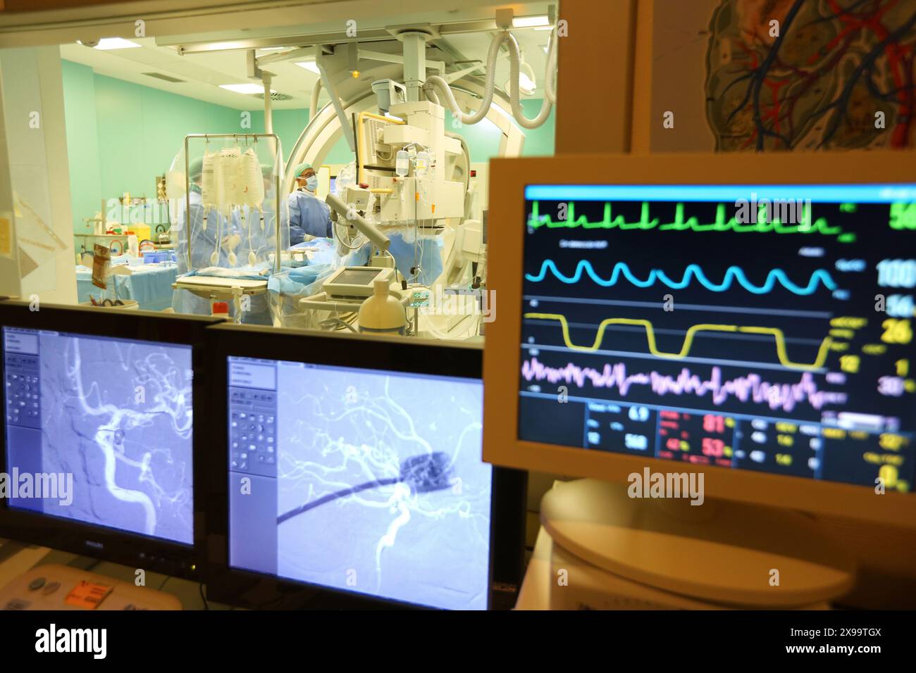 Cerebral aneurysm embolization, Willis polygone Angiography ...
