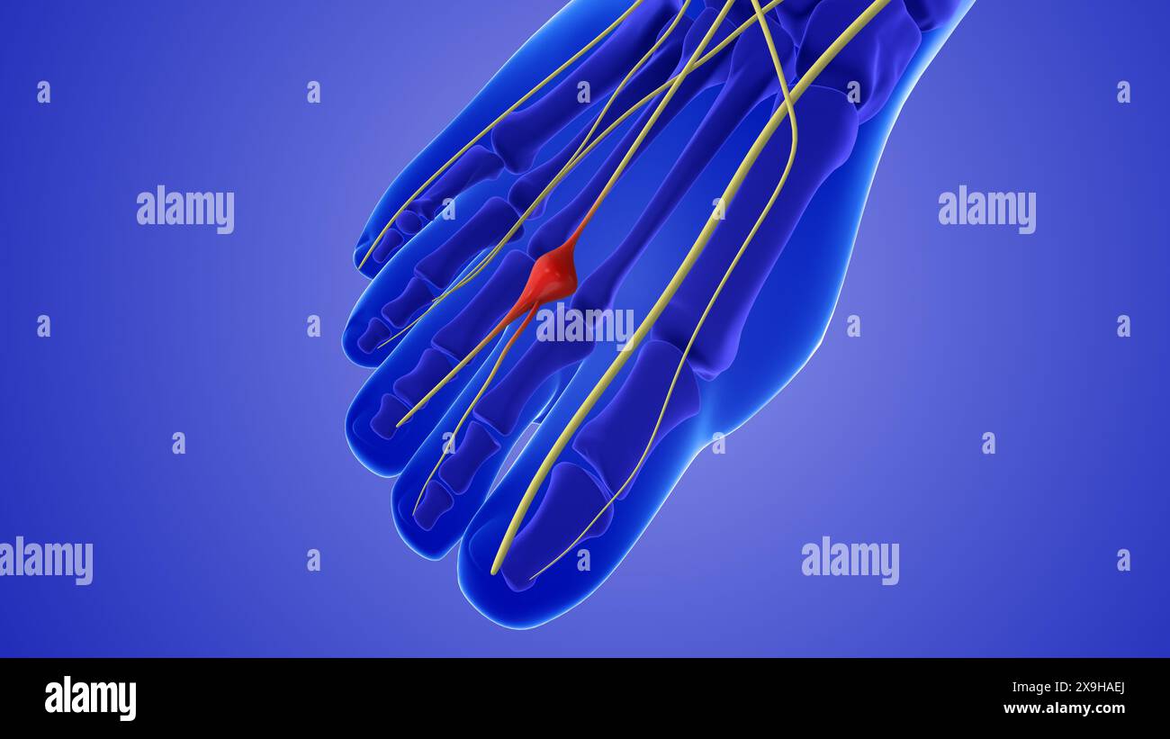 Medical animation of a neuroma or pinched nerve Stock Photo