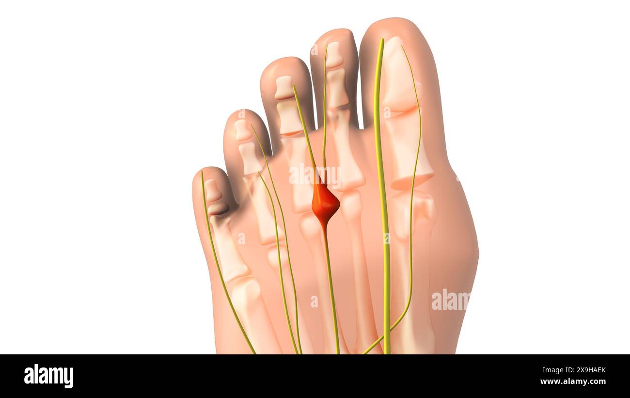 Pinched nerve or neuroma medical animation Stock Photo