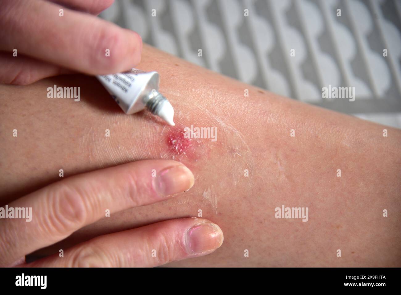 Pictures show a patient receiving treatment after suffering Mosquitoes