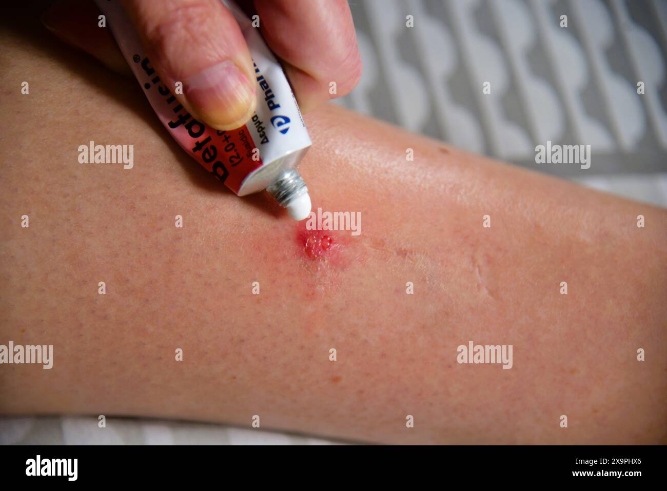 Pictures show a patient receiving treatment after suffering Mosquitoes
