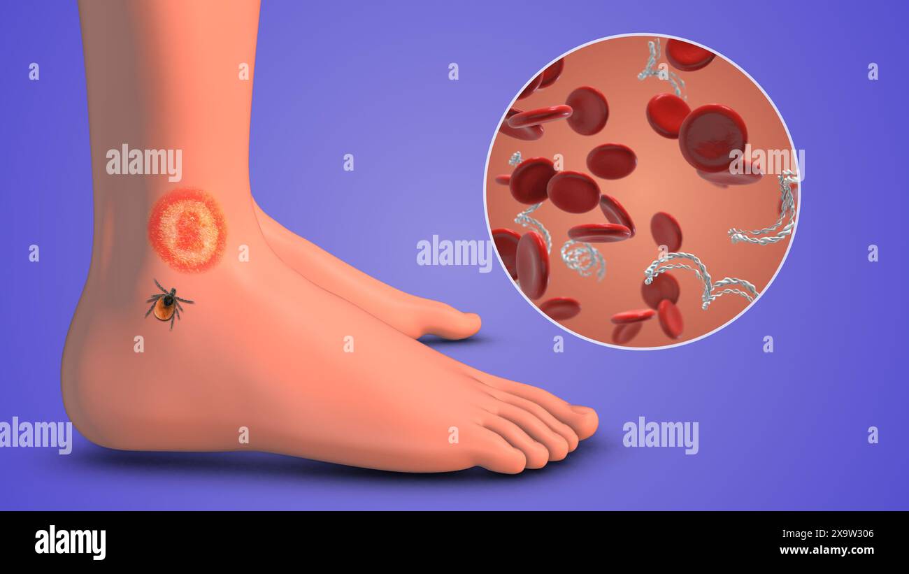 CDC in blood cells with Lyme disease on feet Stock Photo Alamy