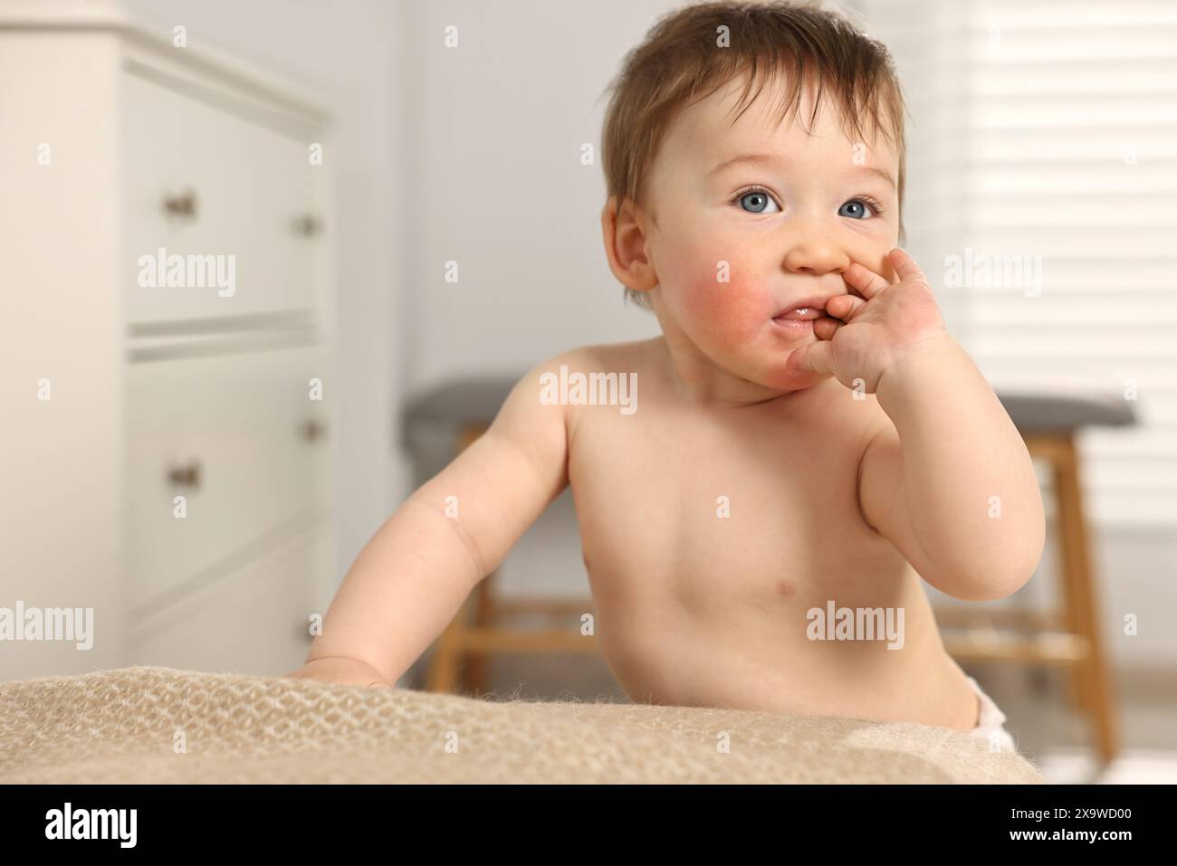 Cute little baby with allergic redness on cheeks indoors Stock Photo