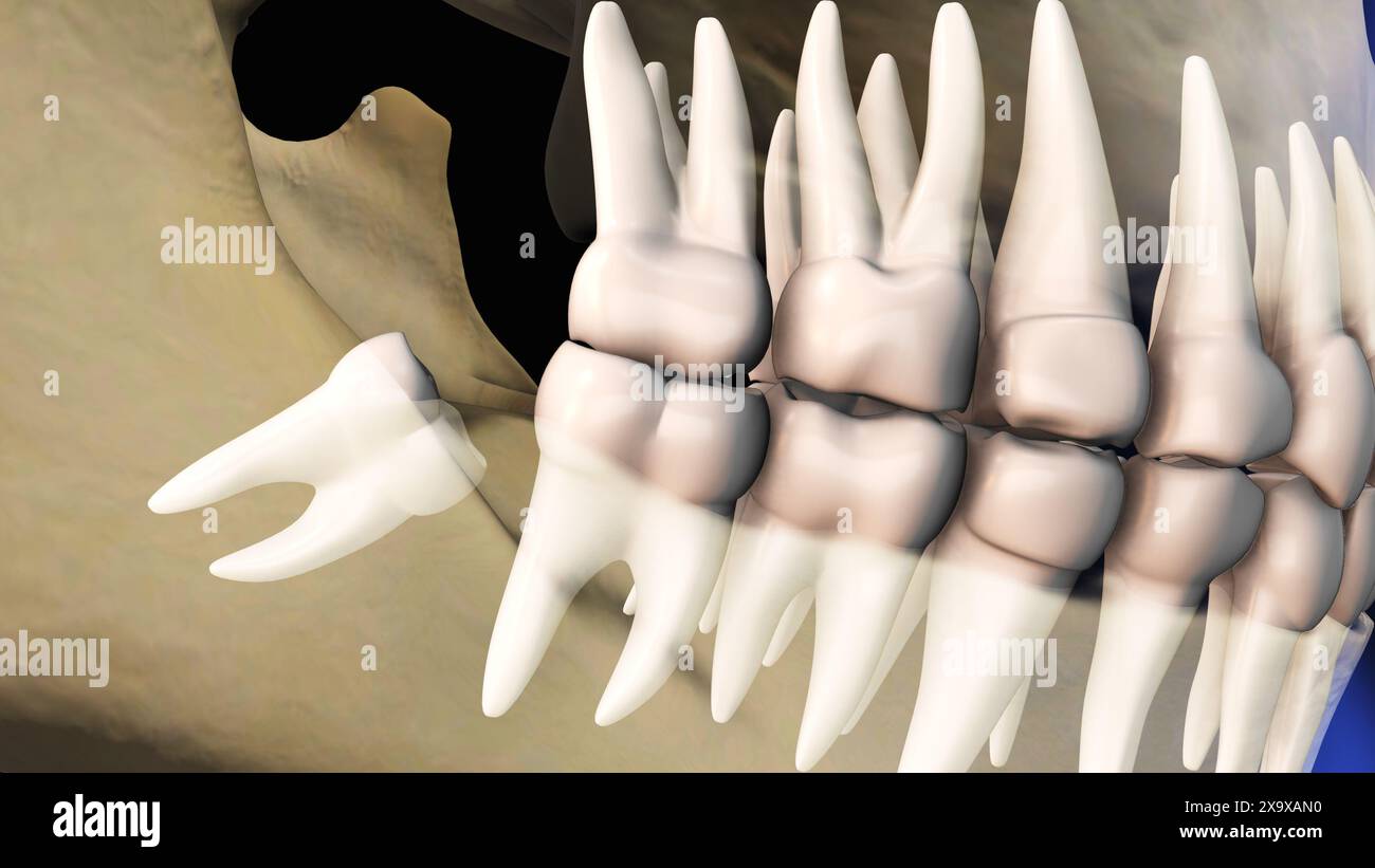 Defleone Tooth Concept of wisdom teeth pain Stock Photo - Alamy