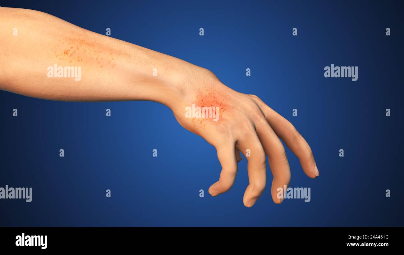 Medical Concept of eczema on hand skin Stock Photo