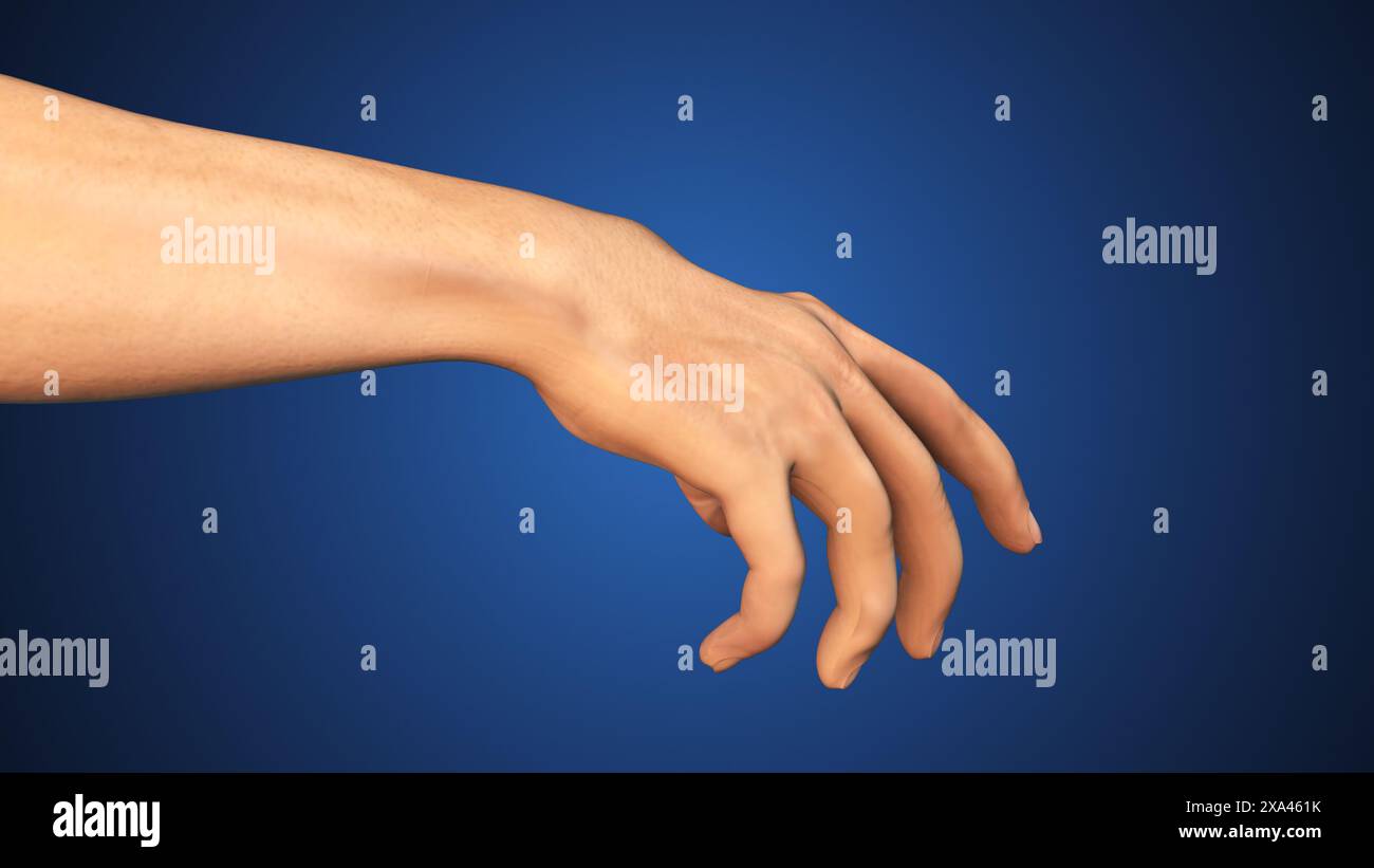 Medical Concept of eczema on hand skin Stock Photo