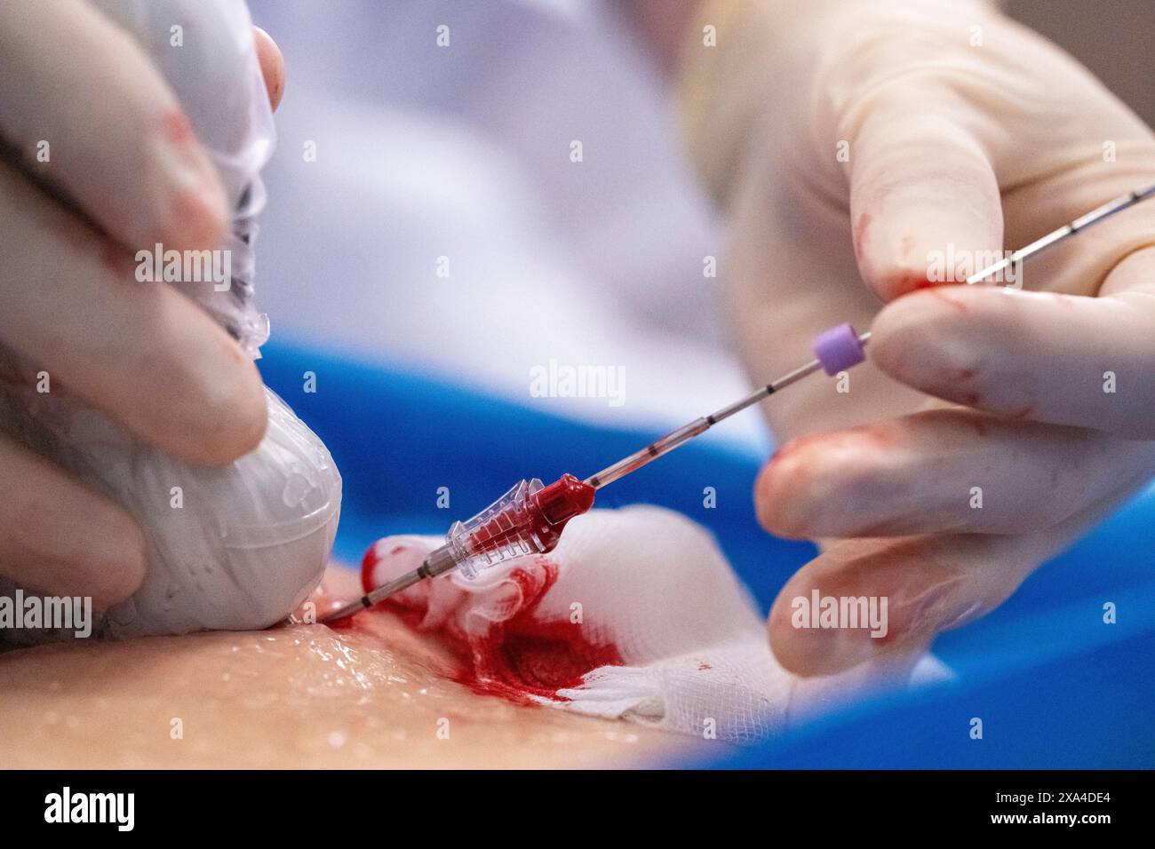 A close-up view of a medical professional's hands, wearing gloves, performing a blood draw or injection on a patient's belly, with cotton and medical supplies visible. Stock Photo