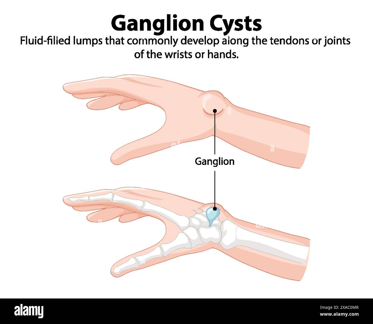 Ganglion Cyst Stock Photos, Images – KGOWXG