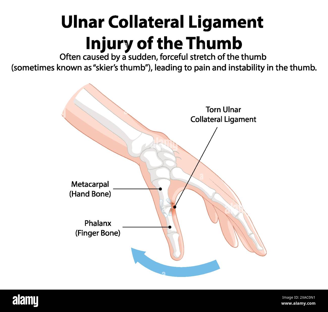 Illustration of thumb ligament injury and affected bones Stock Vector ...
