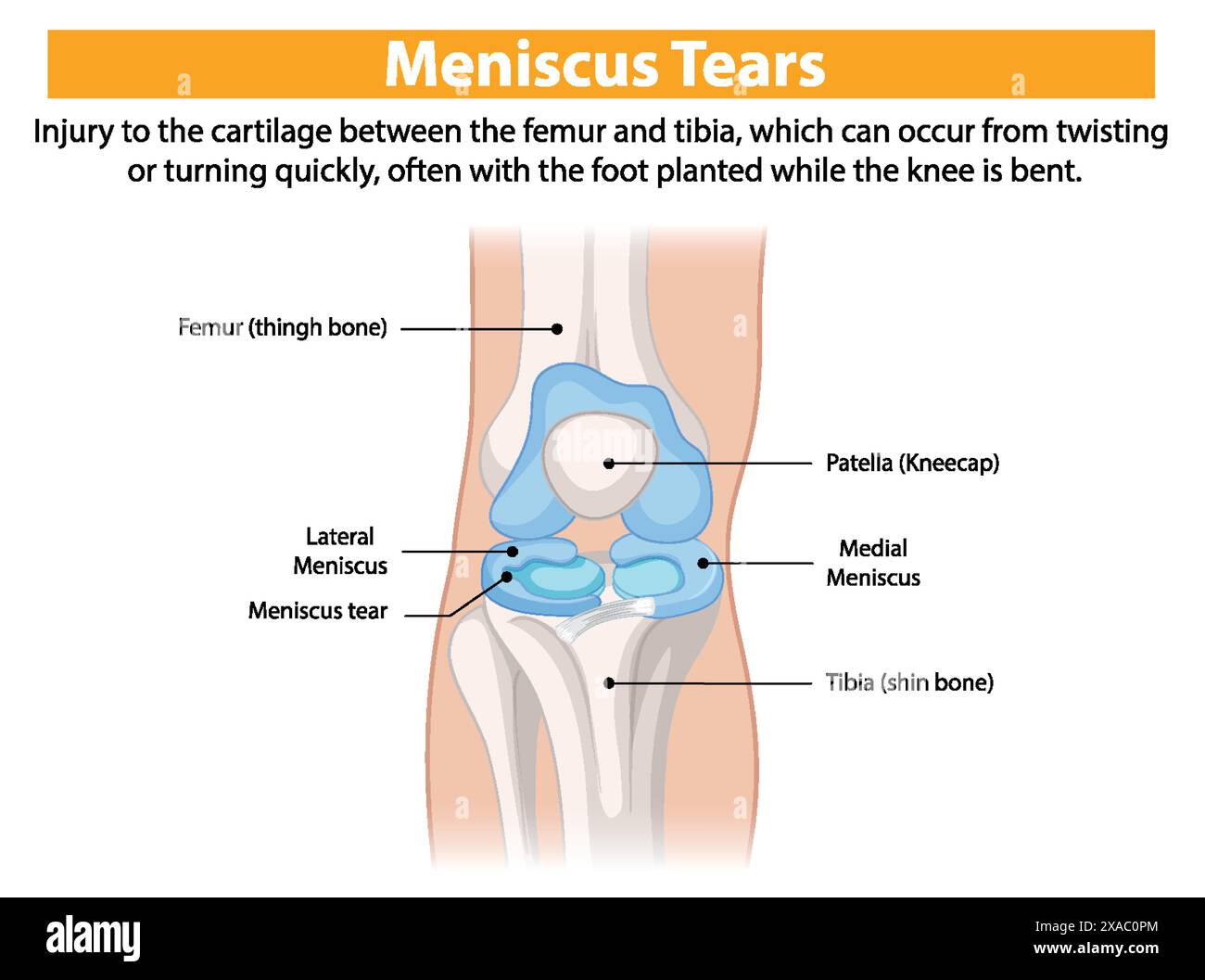 Illustration of knee meniscus tear anatomy Stock Vector Image & Art - Alamy