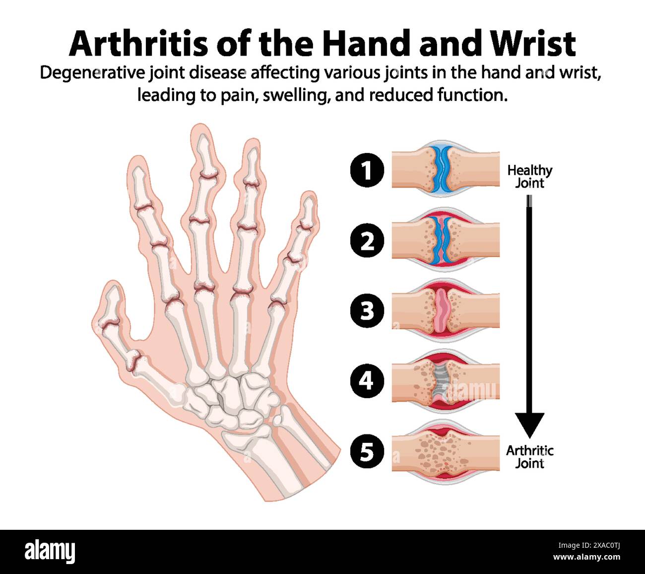 Degenerative joint disease affecting hand and wrist Stock Vector Image
