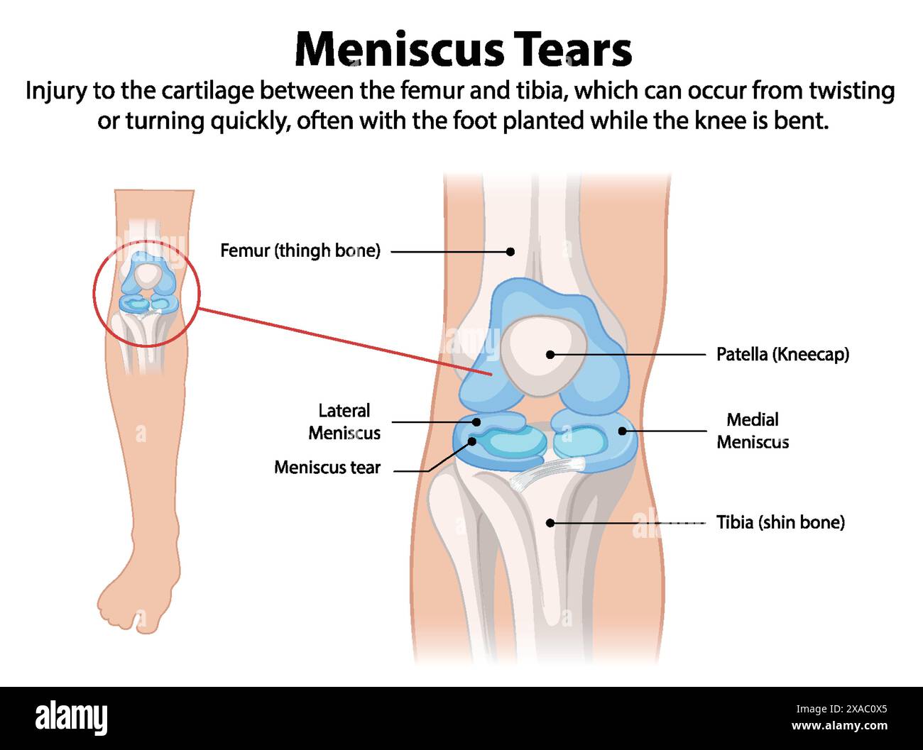 Illustration of knee meniscus tear anatomy Stock Vector Image & Art - Alamy