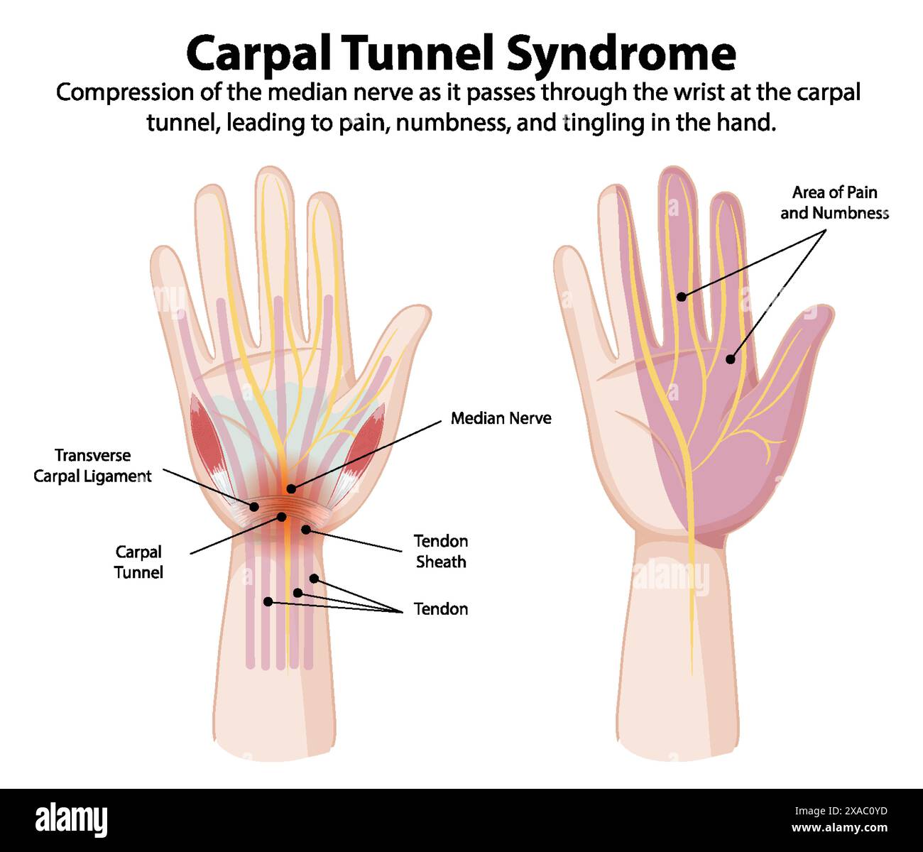 Diagram Showing Carpal Tunnel Syndrome Symptoms Stock Vector Image Diagram showing carpal tunnel syndrome symptoms stock vector image