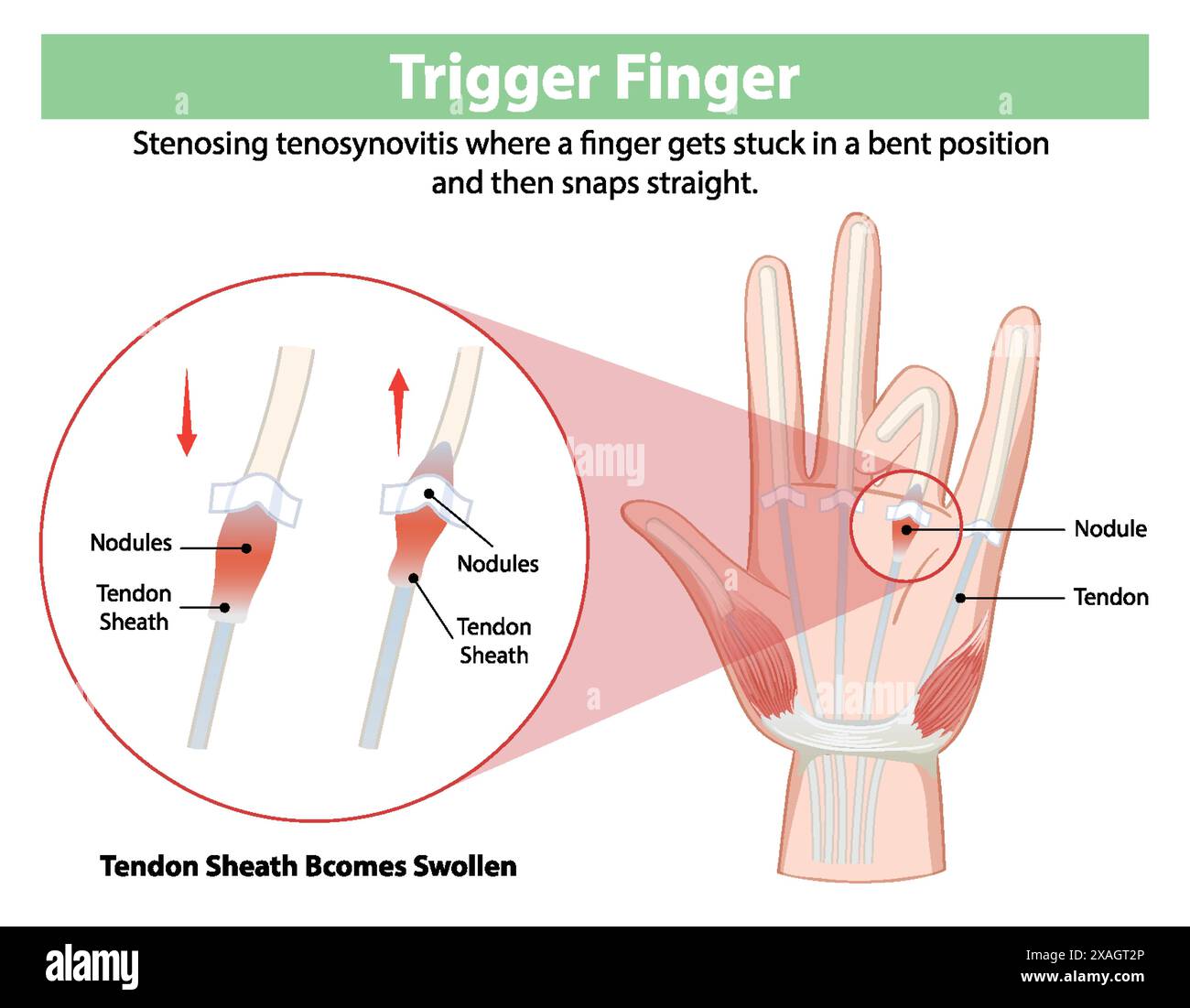 Diagram explaining trigger finger condition and symptoms Stock Vector ...