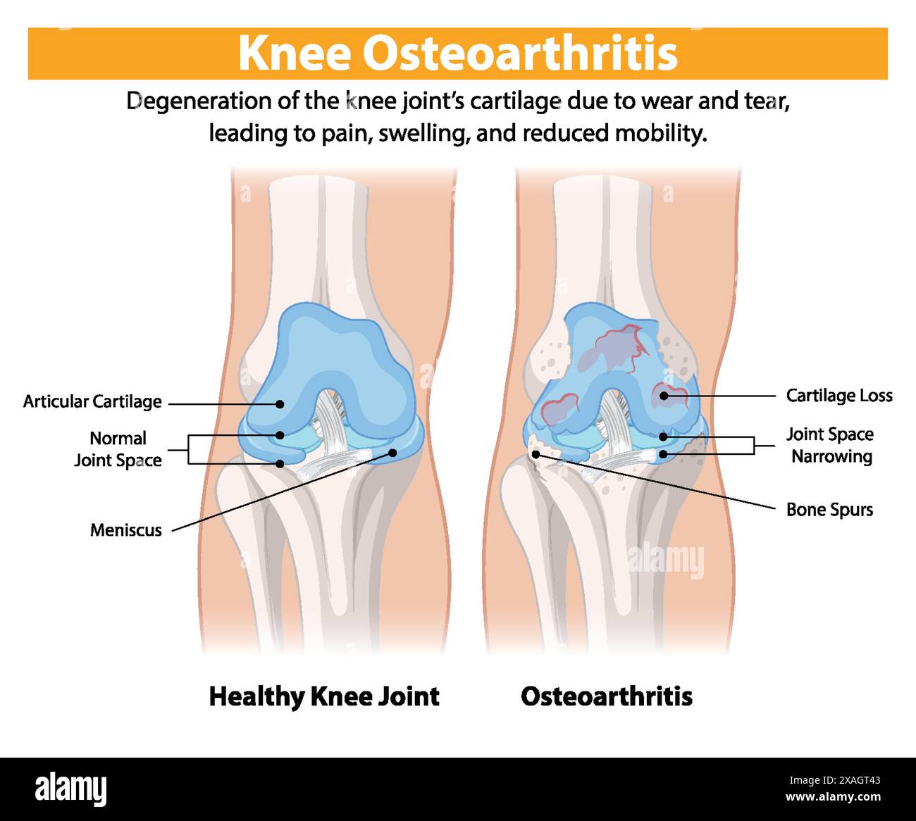 Versus Oa Knee