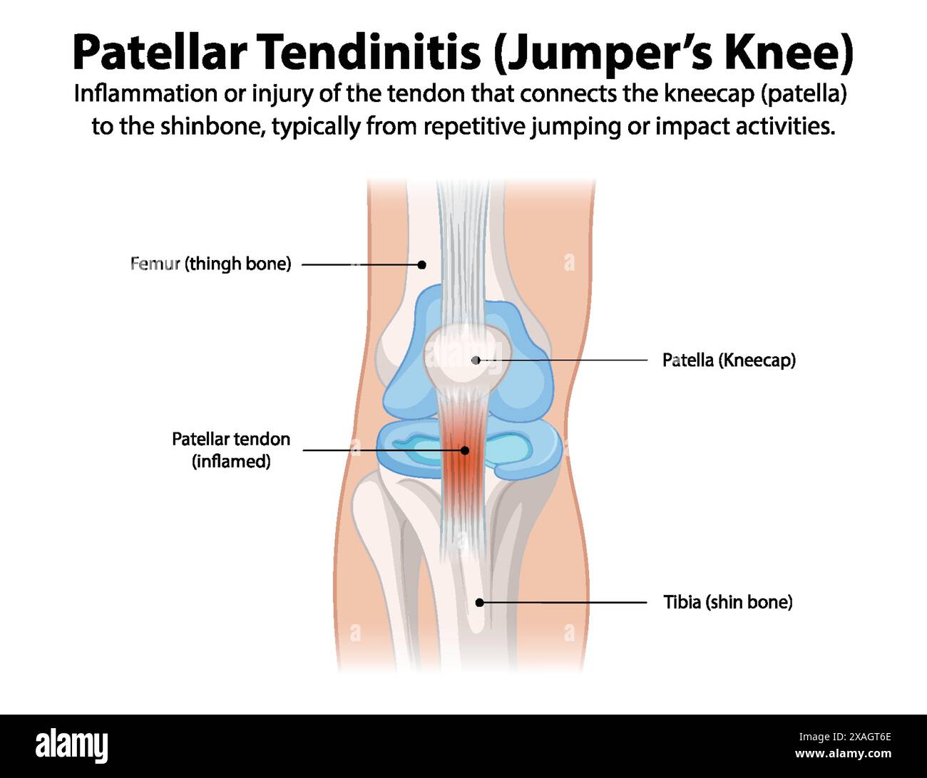 Diagram of knee showing patellar tendinitis Stock Vector Image & Art ...