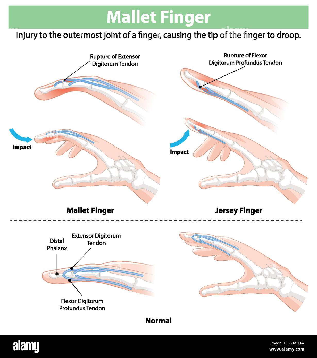 Diagram showing mallet and jersey finger injuries Stock Vector Image ...