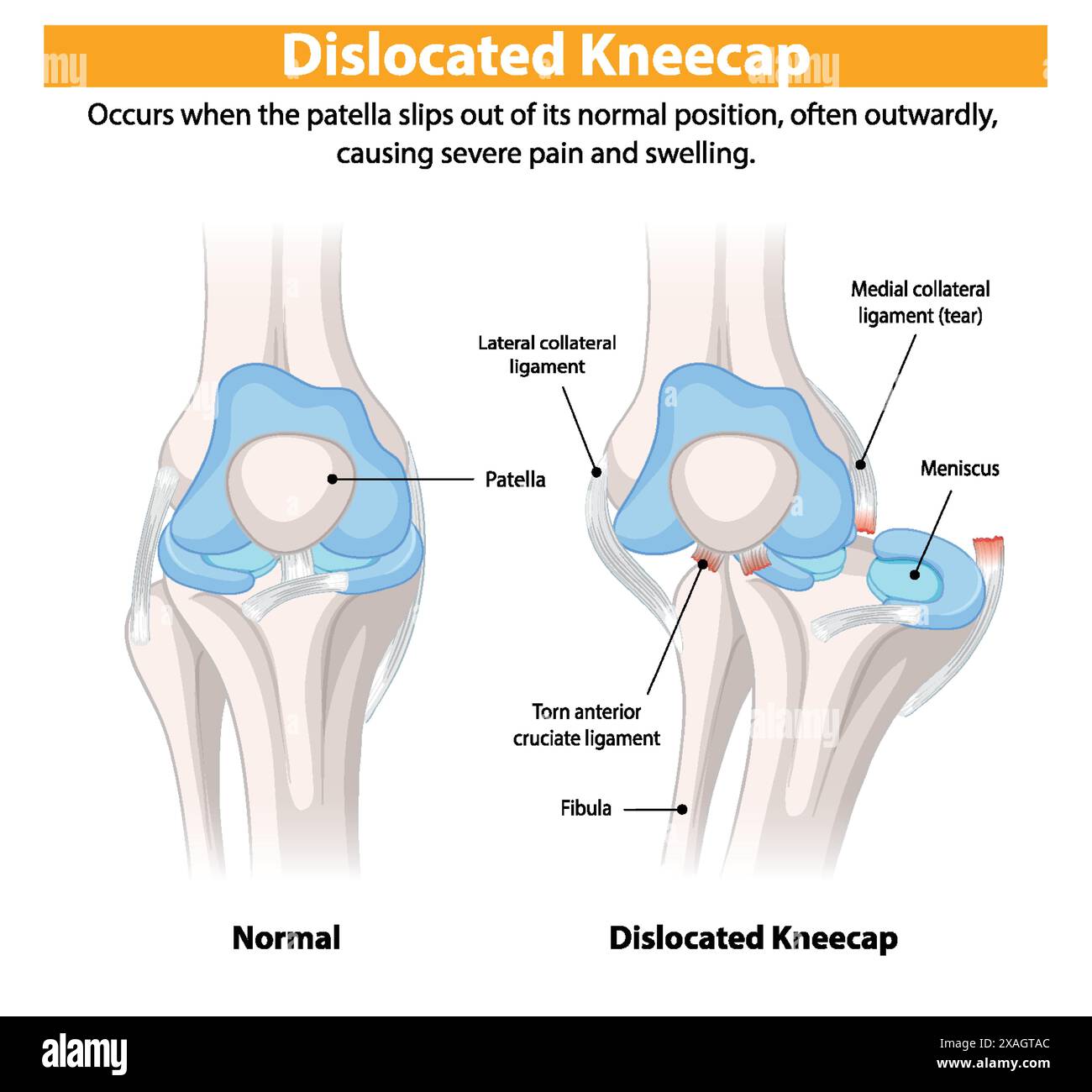 Dislocation Notes Comparison of normal and dislocated kneecap Stock Vector Image & Art ...