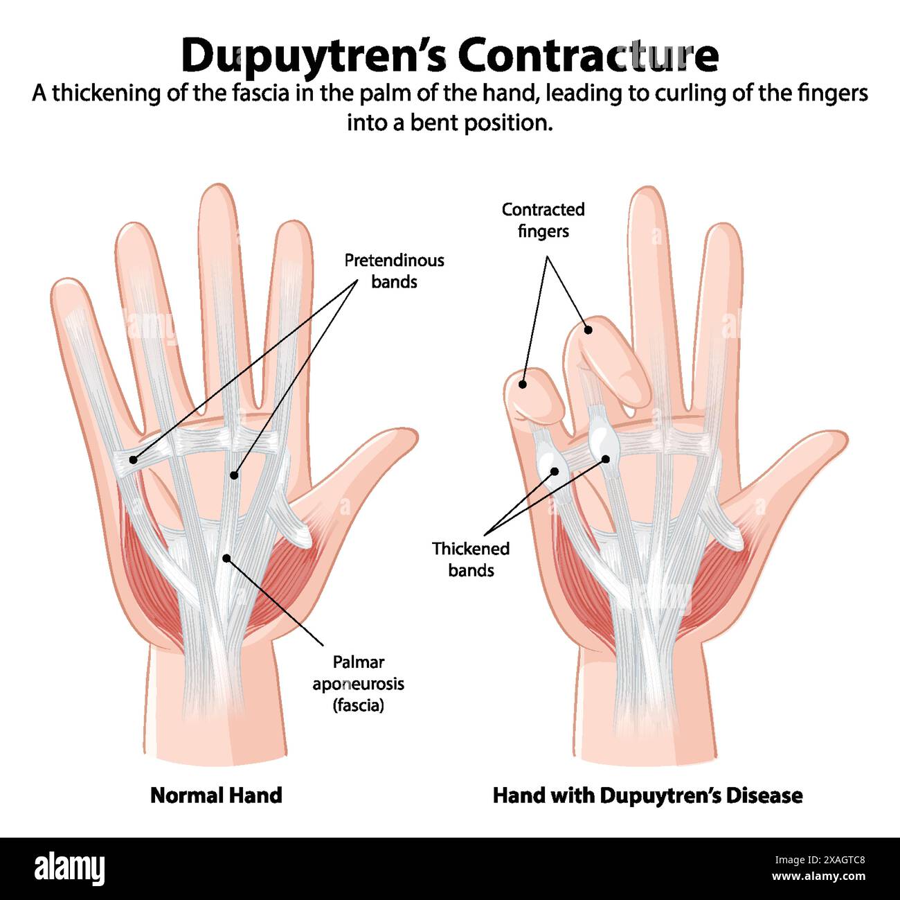 Normal hand vs. hand with Dupuytren's disease Stock Vector Image & Art