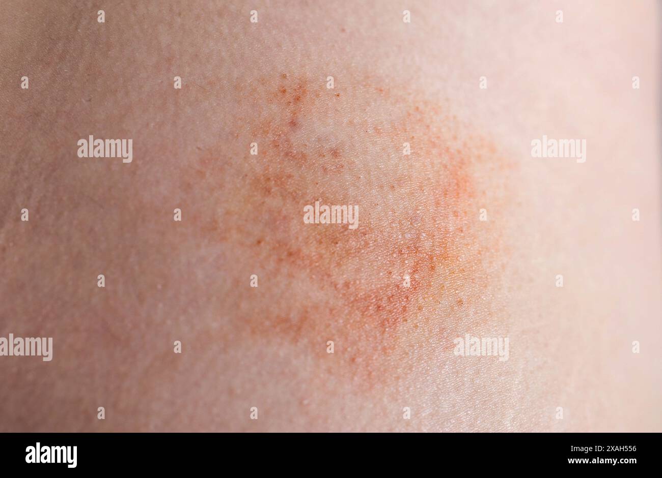 Bruise and subcutaneous lump on the patient s skin after injections