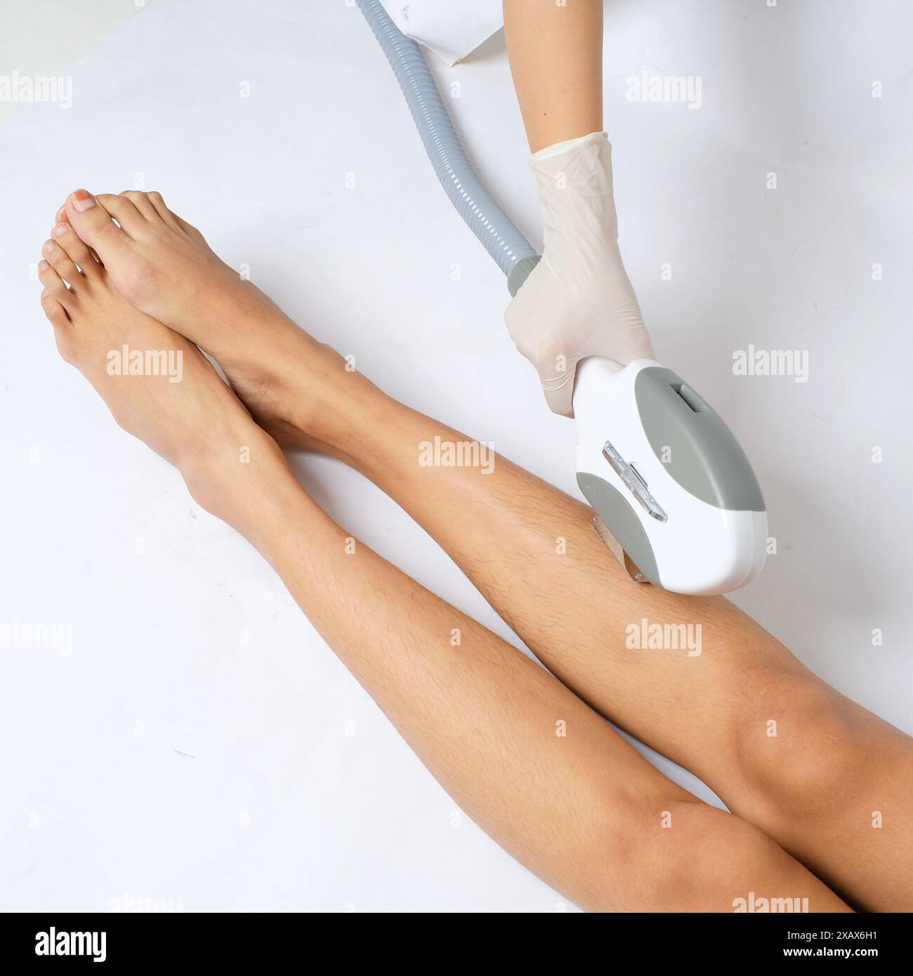 Laser IPL (Intense Pulsed Light) Hair Removal Treatment on Legs Stock