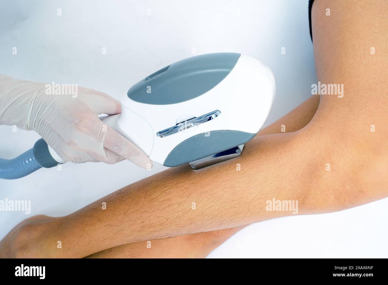 Leg Hair Removal with Laser IPL (Intense Pulsed Light) Treatment Stock Photo