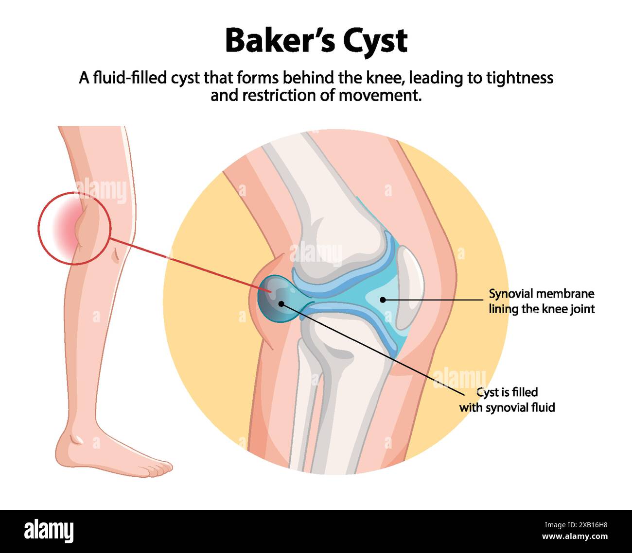 https://c8.alamy.com/comp/2XB16H8/fluid-filled-cyst-causing-knee-tightness-2XB16H8.jpg